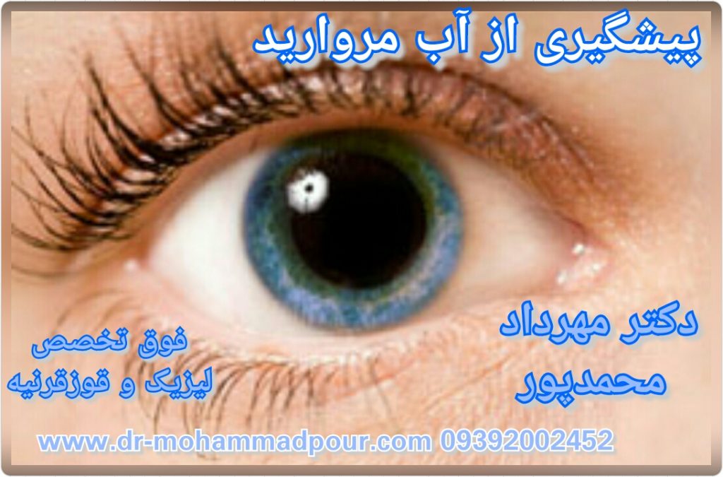 پیشگیری از آب مرواریدCATARACT