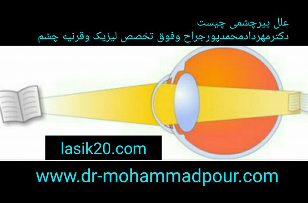 علل پیرچشمیpresbyopia