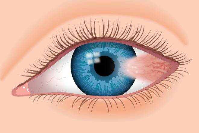 ناخنک یاPterygium