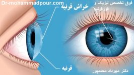 خراشیدگی قرنیه